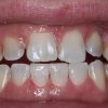 Lower Chipped Tooth After